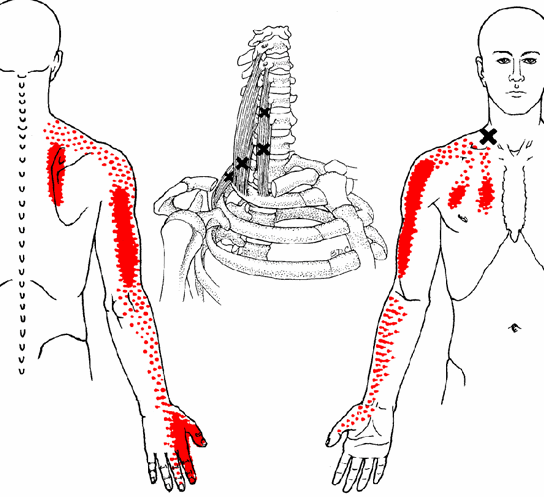 scalene-muscles-trigger-points.gif